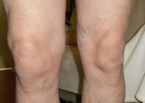 Antes de usar Osteflex, las rodillas de Nils estaban hinchadas al final del día.