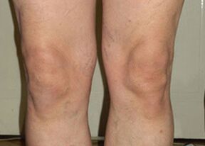 Después de un ciclo de uso de Osteflex, las articulaciones vuelven a la normalidad.